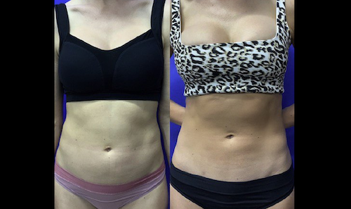 Non Surgical Body Contouring Fat Loss Before After Mississauga Oakville